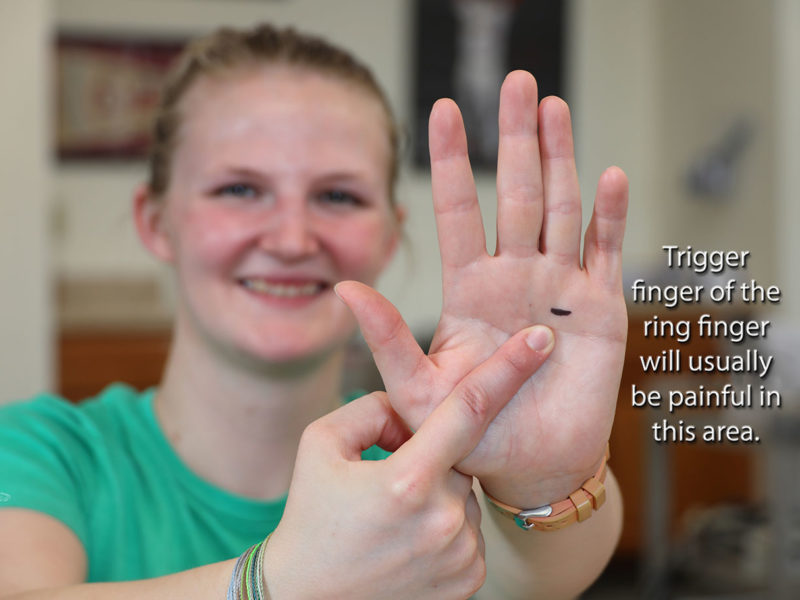 Trigger Finger or Trigger Thumb: Otherwise Known as Stenosing Tenosynovitis