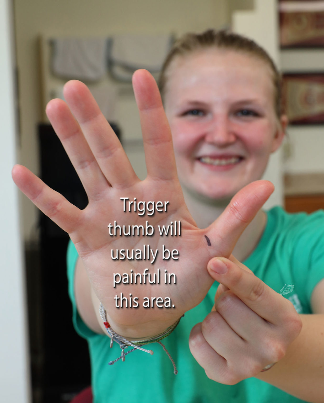 Trigger Finger or Trigger Thumb: Otherwise Known as Stenosing ...